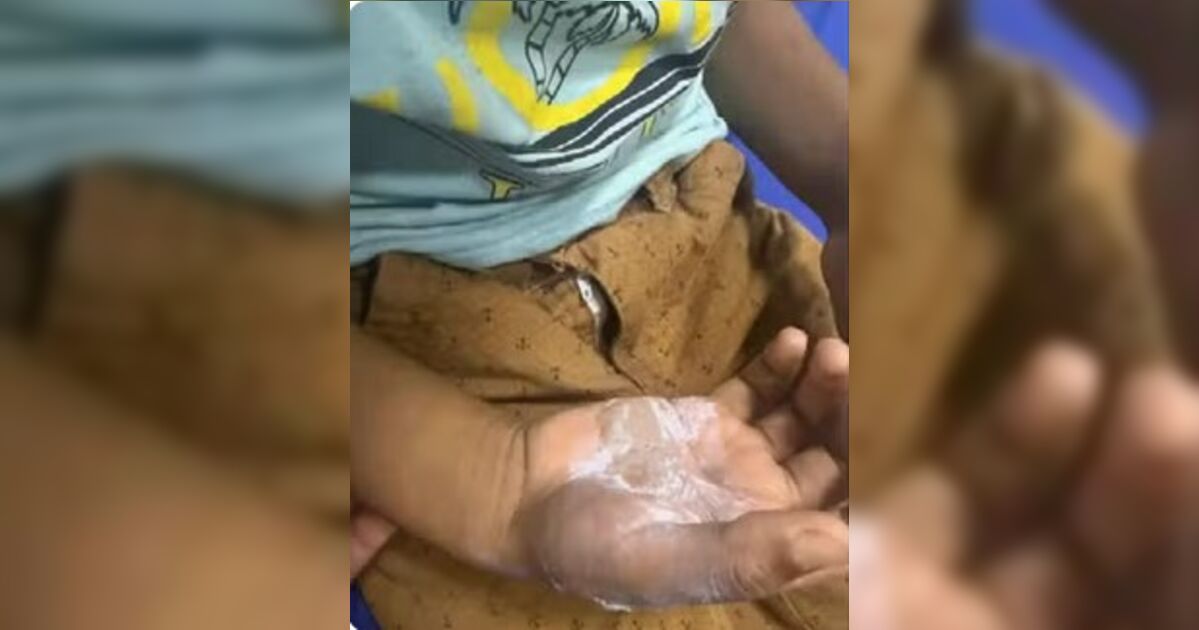 Mãe é presa em Goiás suspeita de queimar o próprio filho com colher quente após castigo